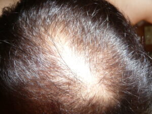 頭頂部ハゲ