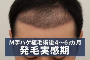 【4〜6ヶ月】発毛再生期（初期成長期）