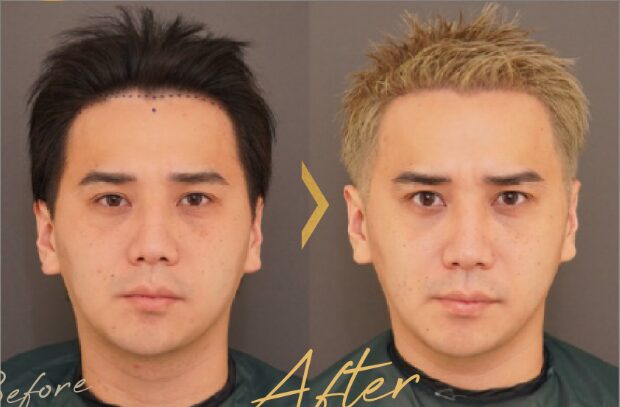 アーククリニック植毛症例