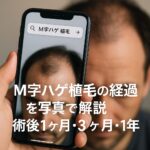 M字ハゲ植毛の経過を写真で解説｜術後1ヶ月・3ヶ月・半年・1年