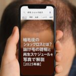 植毛後のショックロスとは？抜け毛の時期と再生スケジュールを写真で解説【2025年版】
