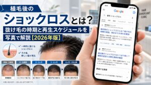 植毛後のショックロスとは?抜け毛の時期と再生スケジュールを写真で解説【2026年版】