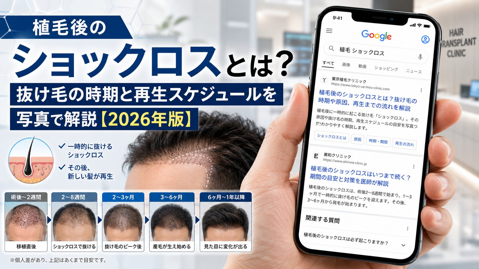 植毛後のショックロスとは？抜け毛の時期と再生スケジュールを写真で解説【2026年版】