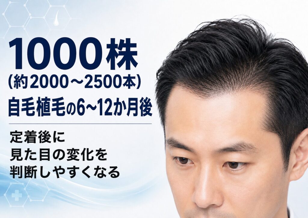 1000株の自毛植毛の6〜12か月後|定着後に見た目の変化を判断しやすくなる